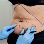 Consulta médica para valorar la cirugía corporal después de adelgazar