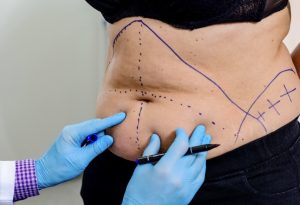 Consulta médica para valorar la cirugía corporal después de adelgazar
